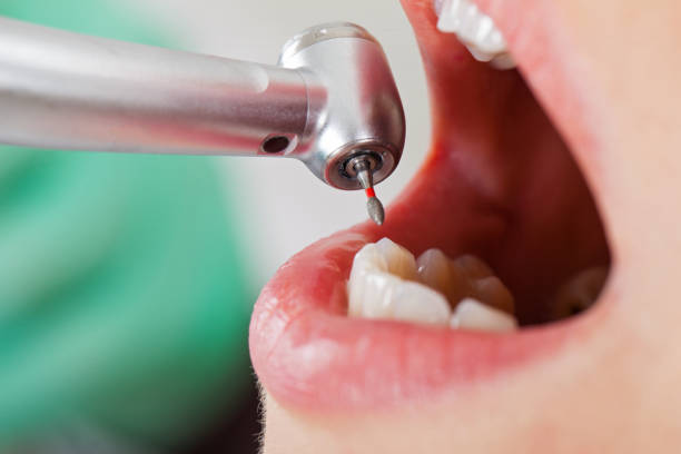 Best Emergency Dental Extractions in Merkel, TX